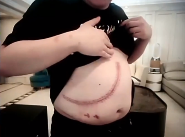 PDD：这次我肝脏直接整个弄掉一半，受损严重